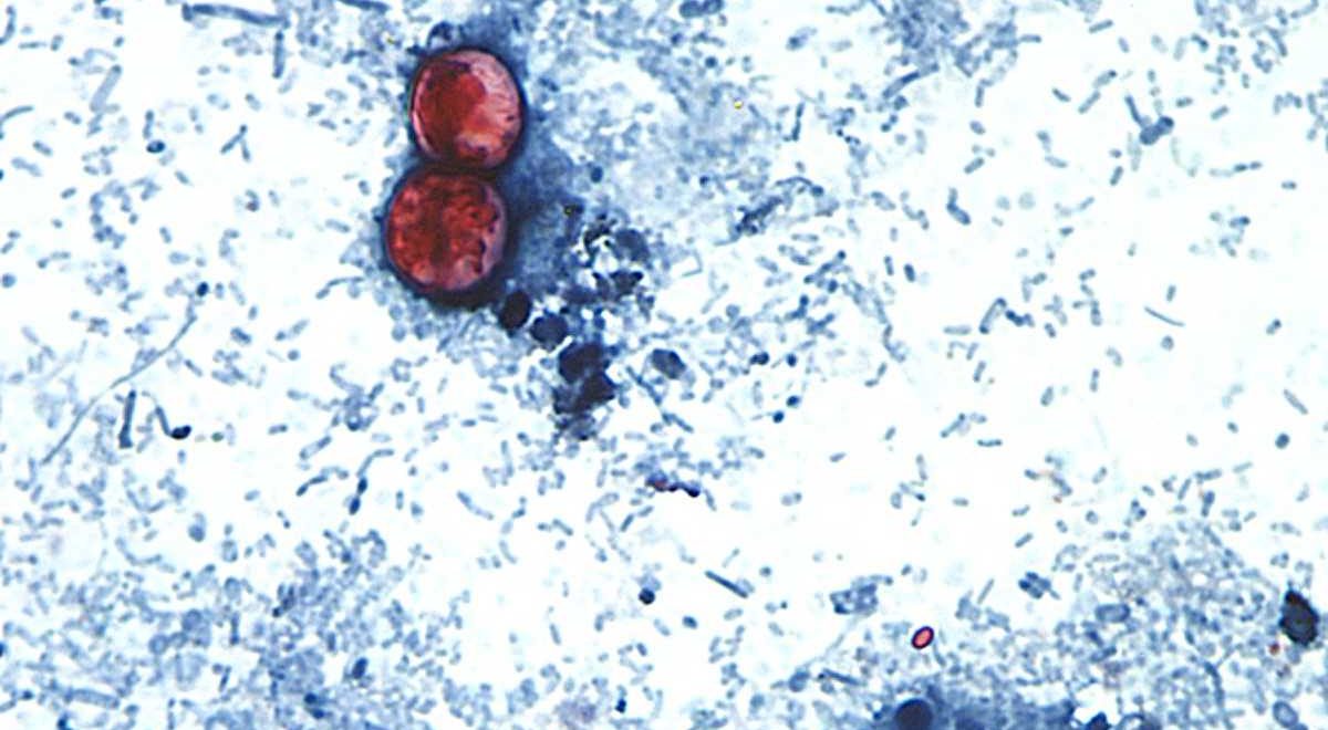 Image credit: NH DHHS: Two cases of cyclosporiasis confirmed in the state in 2026